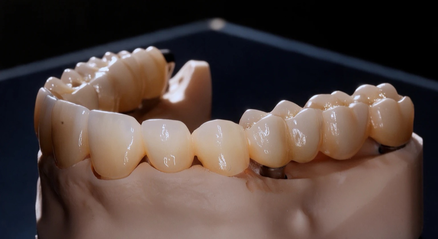 Couronnes et implants pour un sourire harmonieux