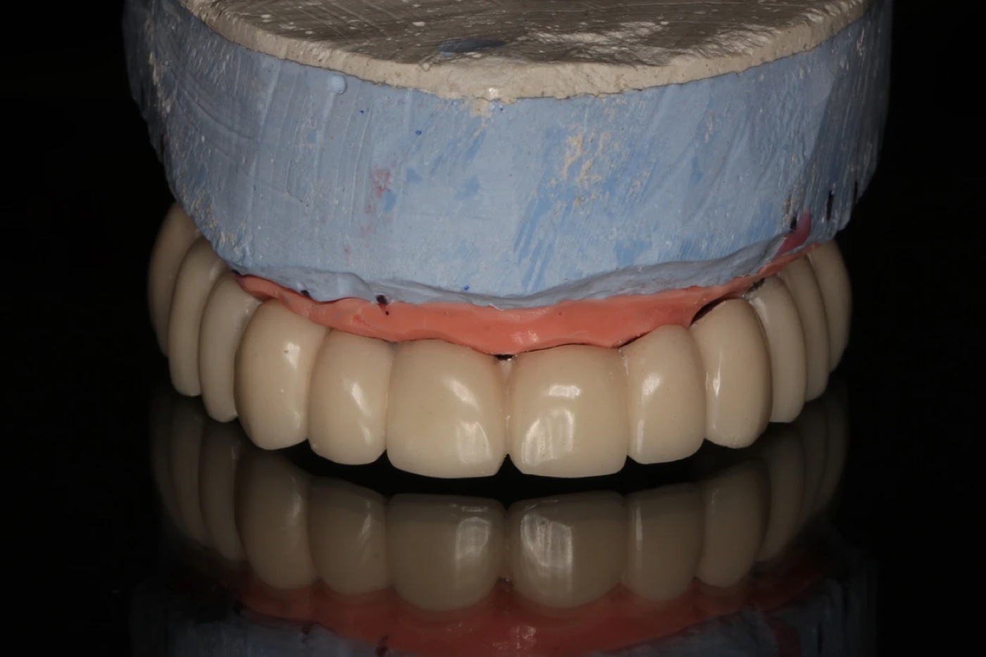 Maxillaire complet avec la technique All‑on‑6 et guide chirurgical